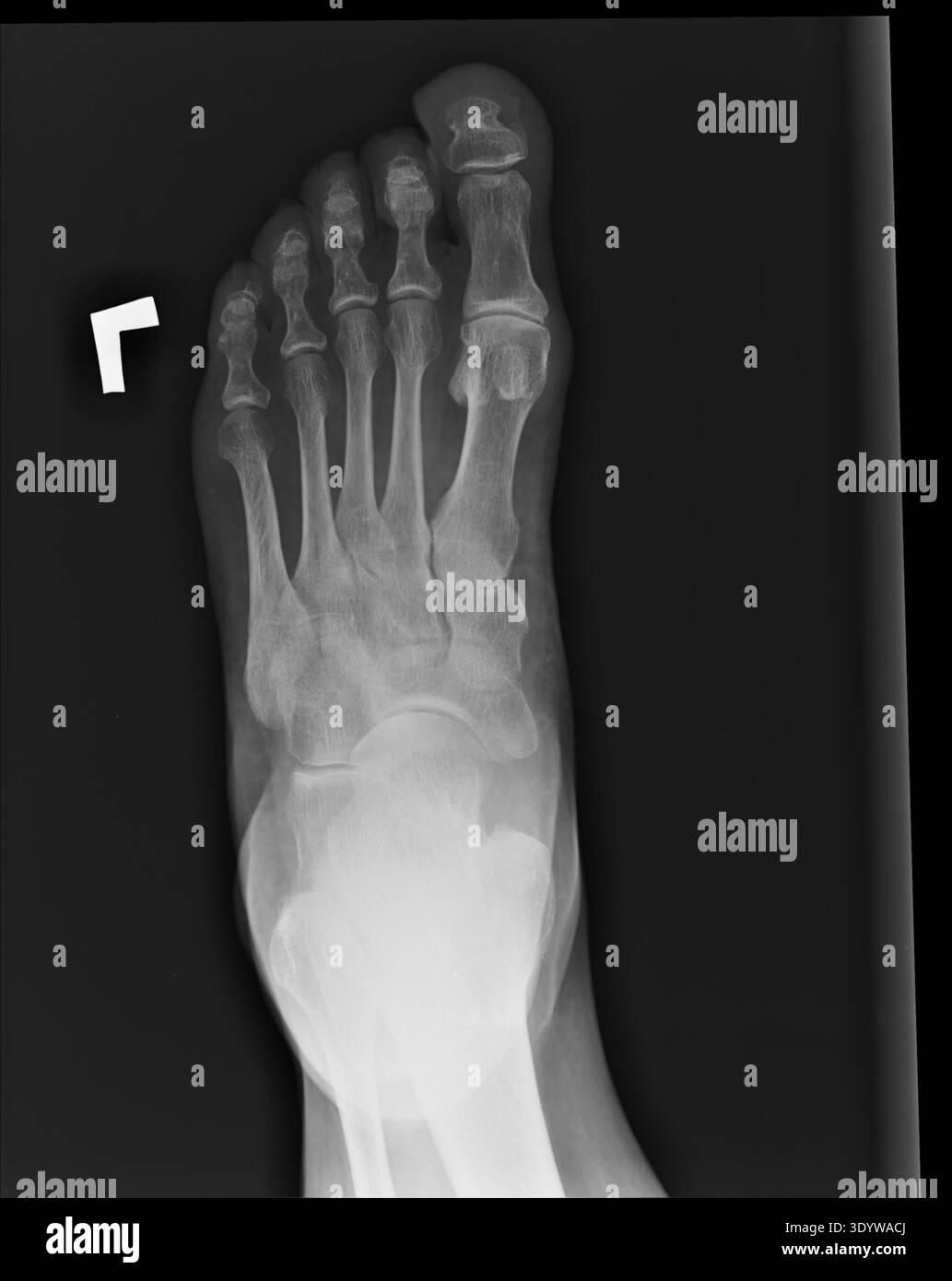 Radiografia (radiografia proiettiva) dei piedi di una femmina di 64 anni, mediante proiezione dorsoplantare Foto Stock