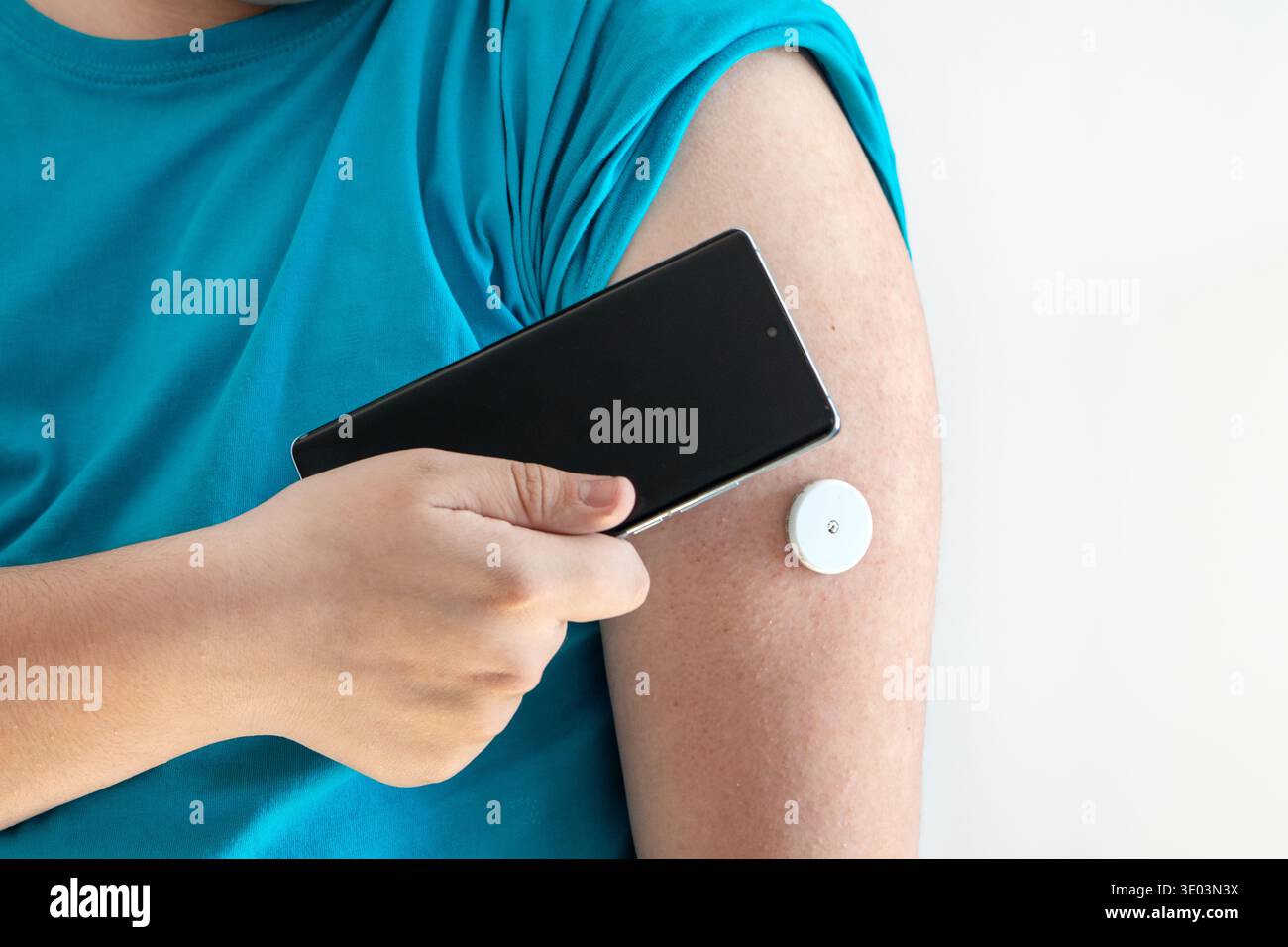 Un uomo in sovrappeso controlla il livello di zucchero nel sangue utilizzando uno smartphone e un sistema di monitoraggio continuo del glucosio. Foto Stock