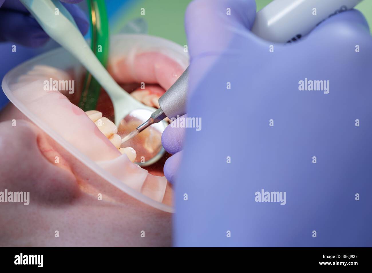 Primo piano del dentista che rimuove la placca con scrostatore a ultrasuoni e specchio in una moderna clinica odontoiatrica. Pulizia professionale dei denti e igiene orale preventiva Foto Stock