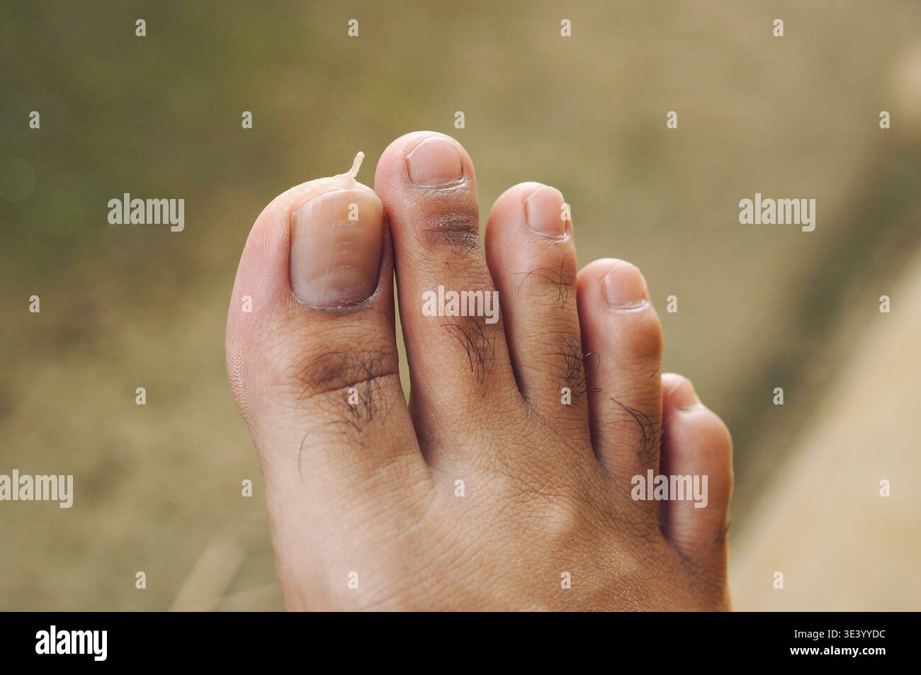 La pelle dell'alluce si è staccata a causa della secchezza. Foto Stock