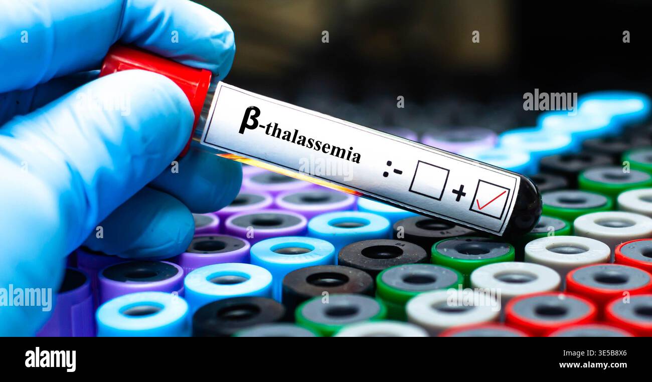 Campione di sangue del paziente risultato positivo per beta talassemia. Foto Stock