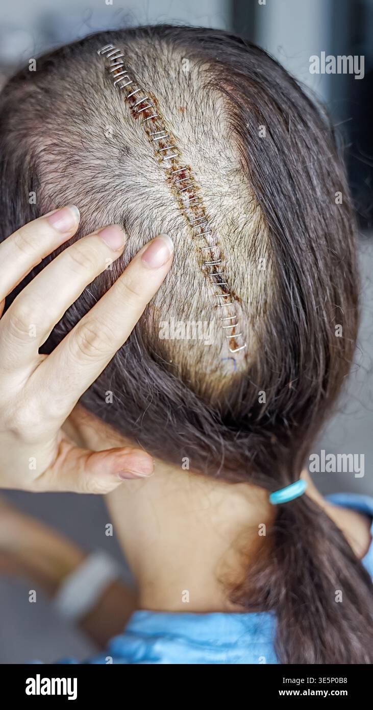 Donna con cicatrice chirurgica visibile dopo un intervento chirurgico di cancro al cervello. Trattamento del tumore cerebrale, recupero oncologico e concetto di sopravvivenza. Foto Stock