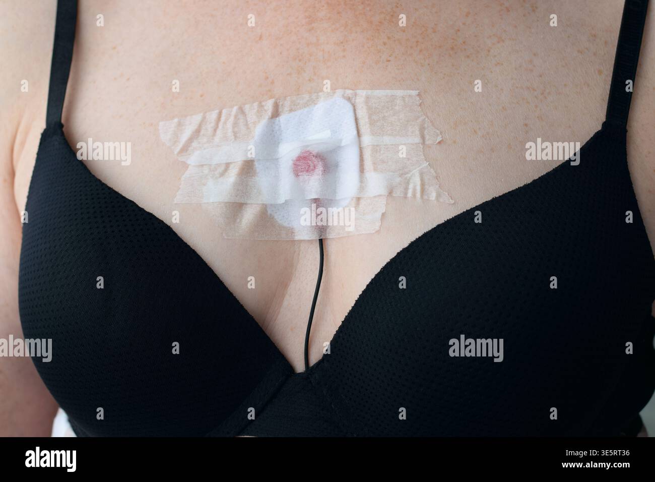 Petto donna da primo piano in reggiseno nero con elettrodo holter applicato alla pelle al centro. Dettagli del dispositivo medico che evidenziano il monitoraggio cardiaco, diag Foto Stock
