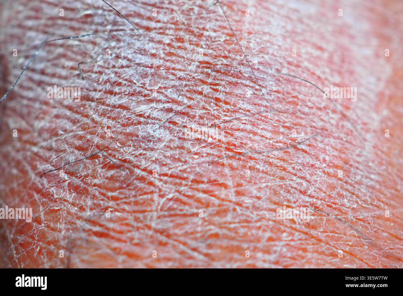 Vista ravvicinata della pelle secca su una mano umana con luce naturale Foto Stock