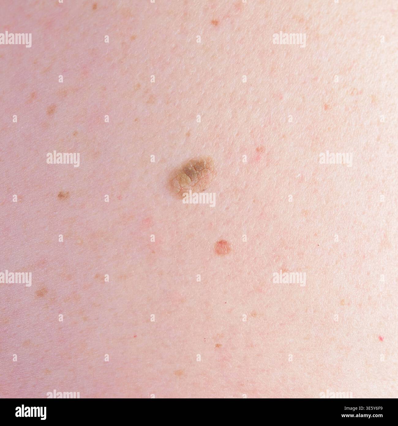 Primo piano della cheratosi sulla pelle umana sotto lente d'ingrandimento per l'esame dermatologico e la consapevolezza del cancro della pelle Foto Stock
