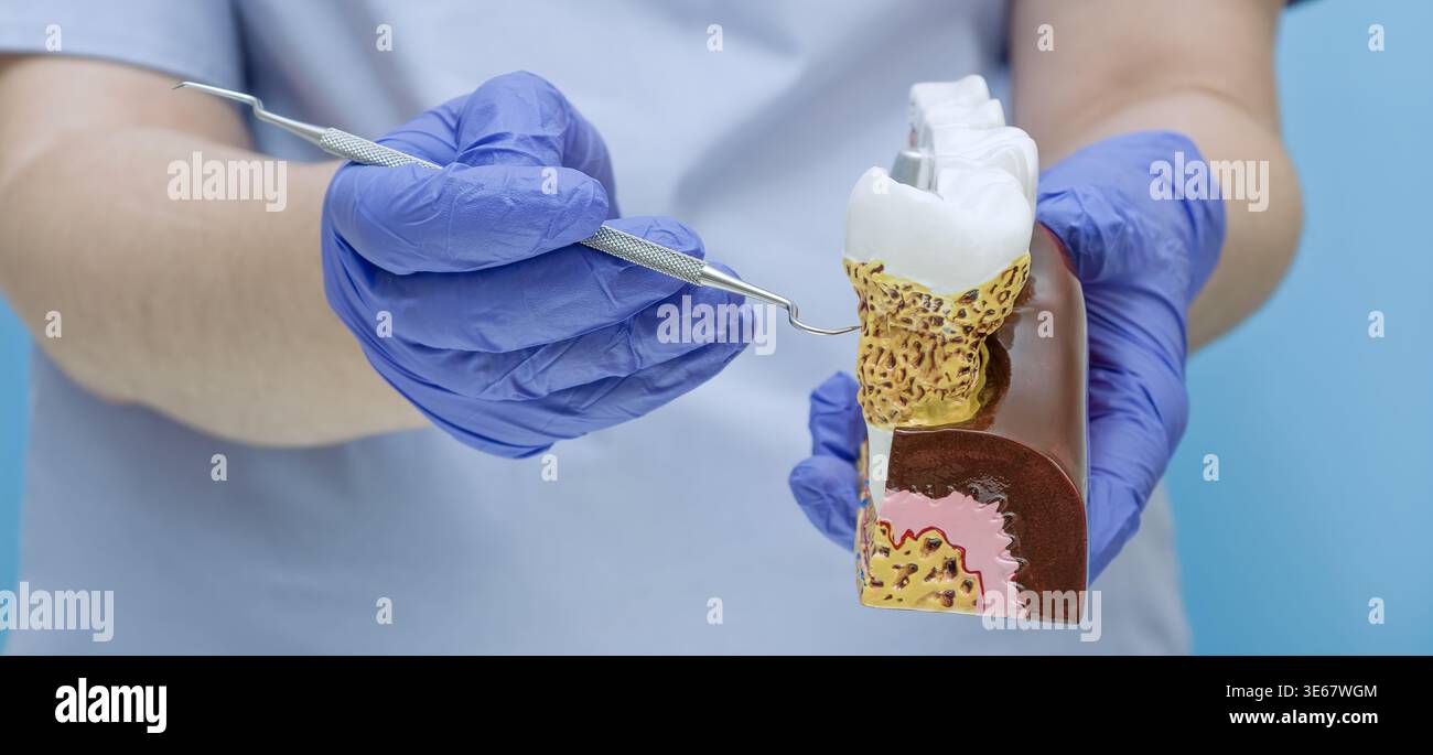 Primo piano di un dentista con guanti in nitrile blu che tengono un modello medico di denti con calcoli dentali visibili, tartaro e sintomi gengiviti. Foto Stock