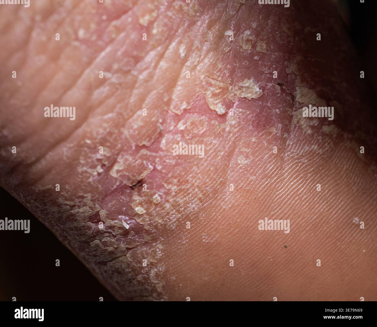 Pelle del tallone danneggiata con secchezza e sbavature, concetto di cura dei piedi, igiene e necessità di trattamento o idratazione Foto Stock