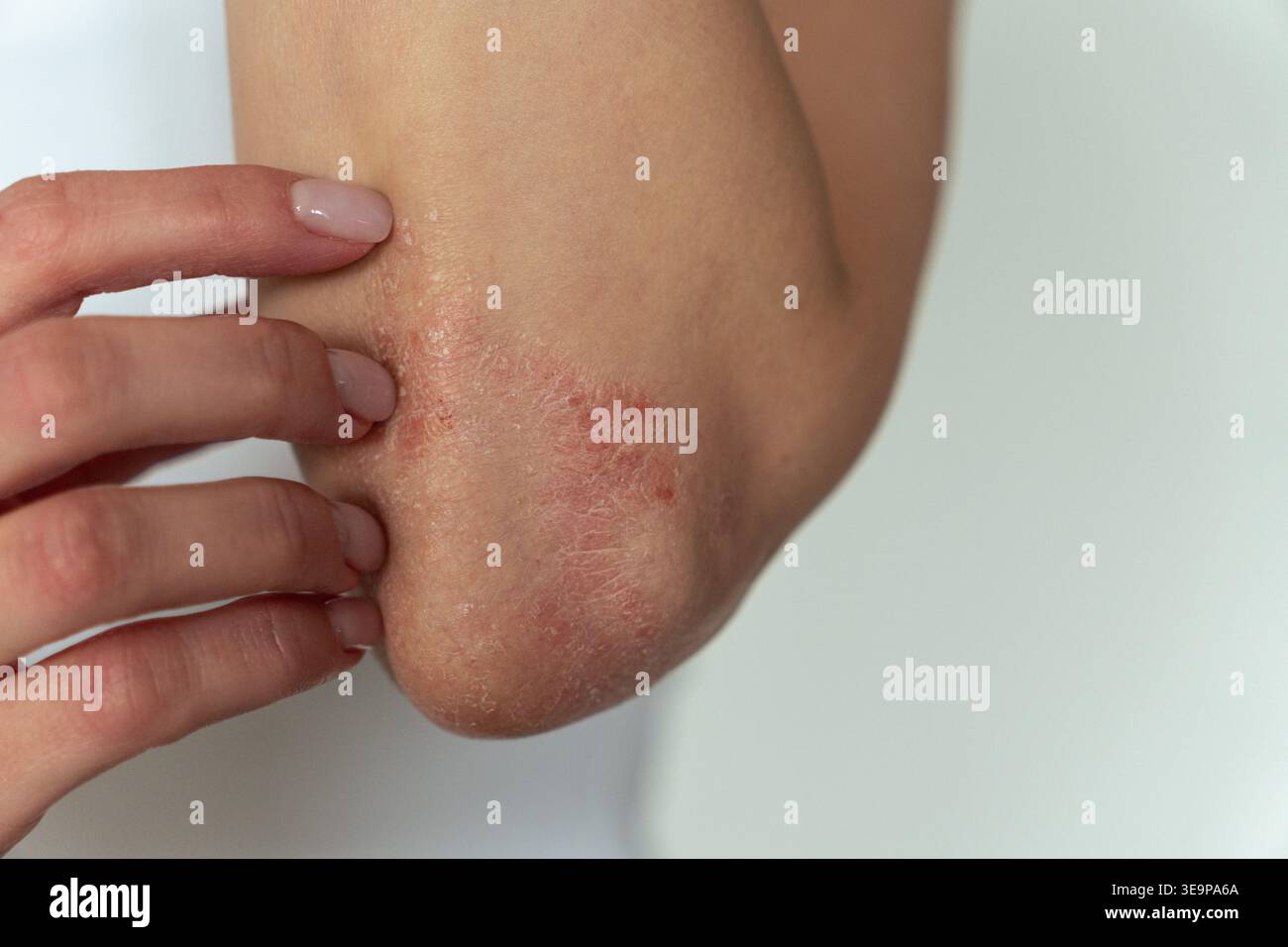 Giovane donna che si gratta il gomito affetto da psoriasi. Dermatologia, malattia cronica della pelle, sintomo prurito e concetto di trattamento della pelle. Orizzontale Foto Stock