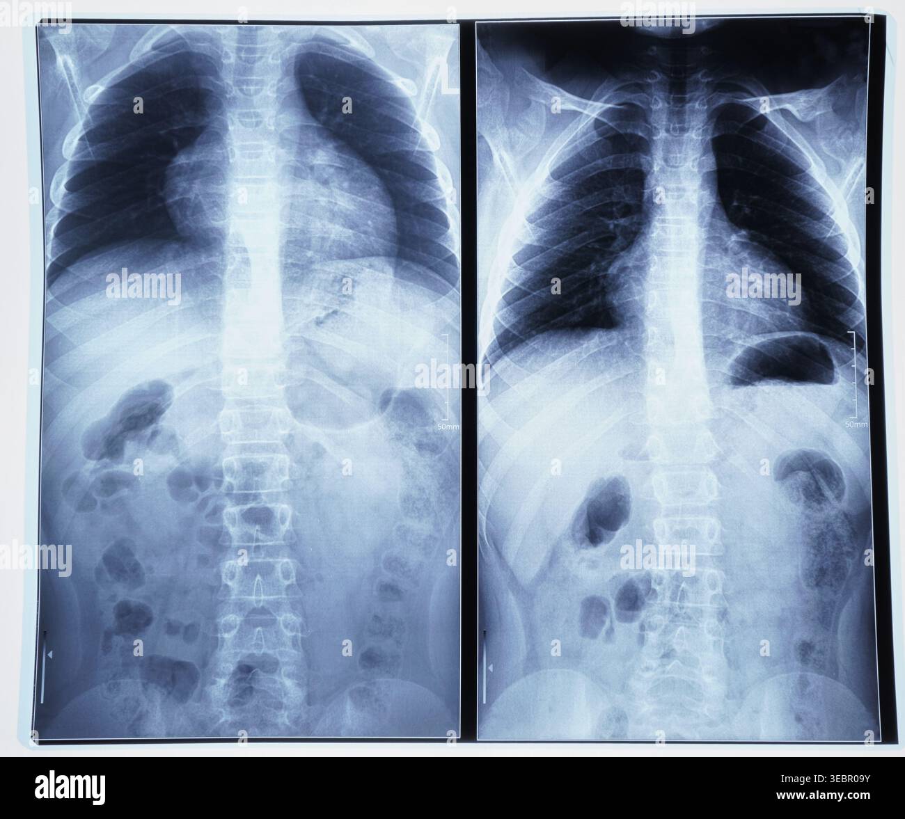 Imaging radiografico dettagliato che mostra la struttura del torace e le possibili anomalie nella colonna vertebrale umana Foto Stock