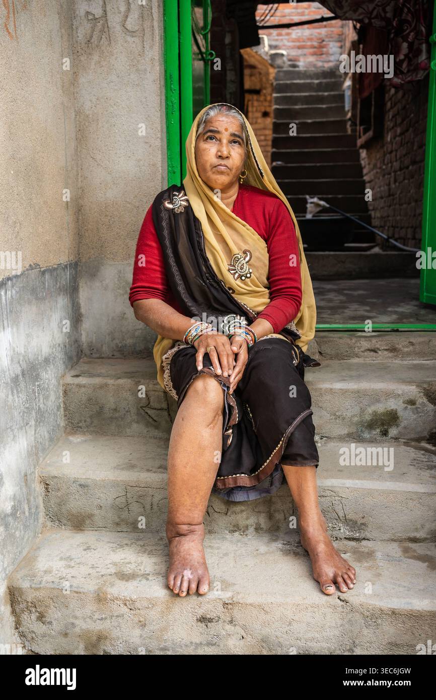 Una donna siede su gradini di pietra all'aperto, il suo sguardo rivolto verso l'alto in modo premuroso e premuroso a Bihar, India, la sua gamba notevolmente gonfia è visibl Foto Stock
