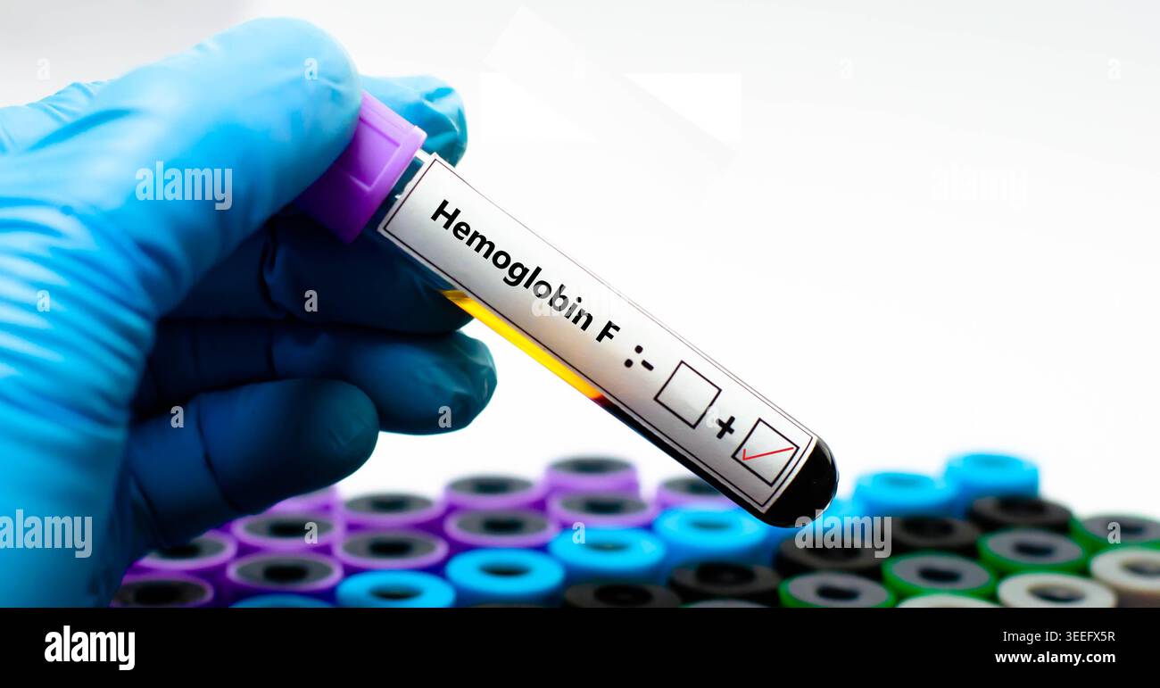 Campione di sangue del paziente risultato positivo per emoglobina F.. Foto Stock