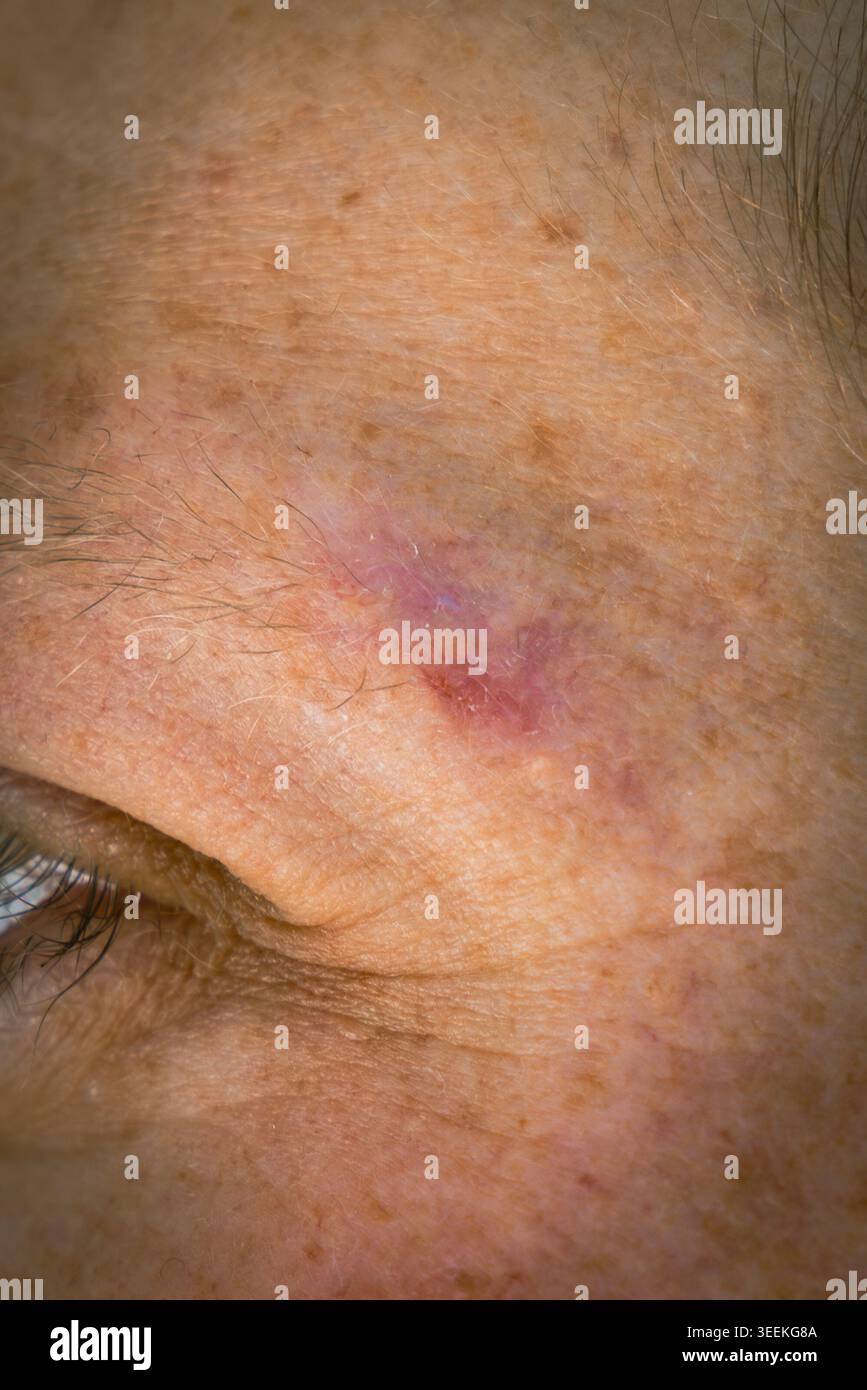 Primo piano estremo di un carcinoma basocellulare sulla sopracciglia sinistra di un maschio adulto, che presenta ammaccature, scolorimento e caratteristiche della lesione prima di Moh Foto Stock