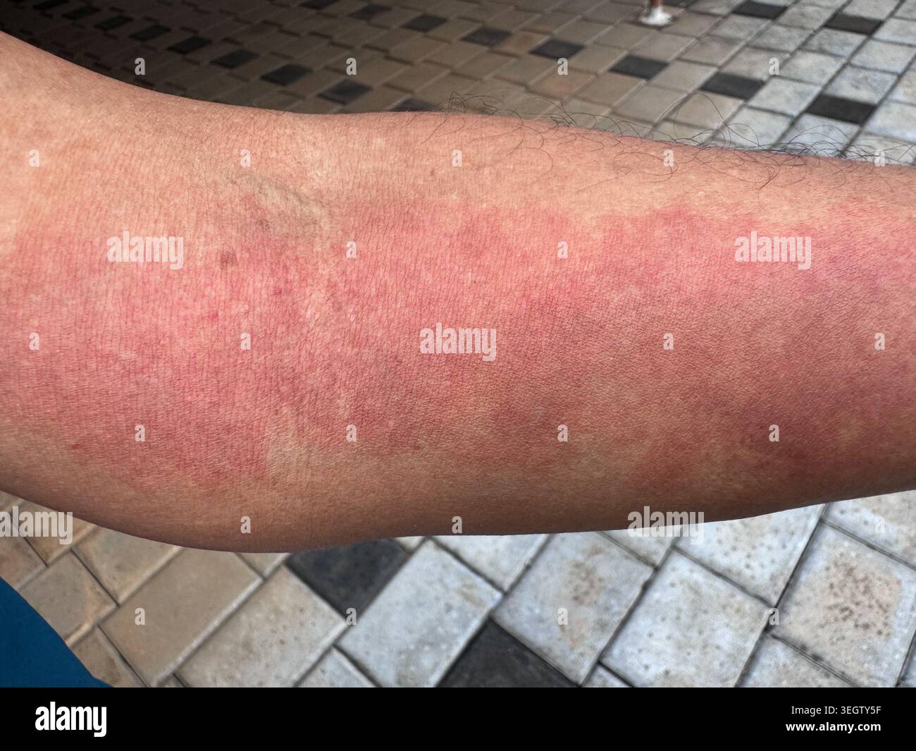 primo piano dettagliato che mostra un'intensa eruzione cutanea infiammatoria rossa, eritema o dermatite allergica sull'avambraccio di una persona Foto Stock