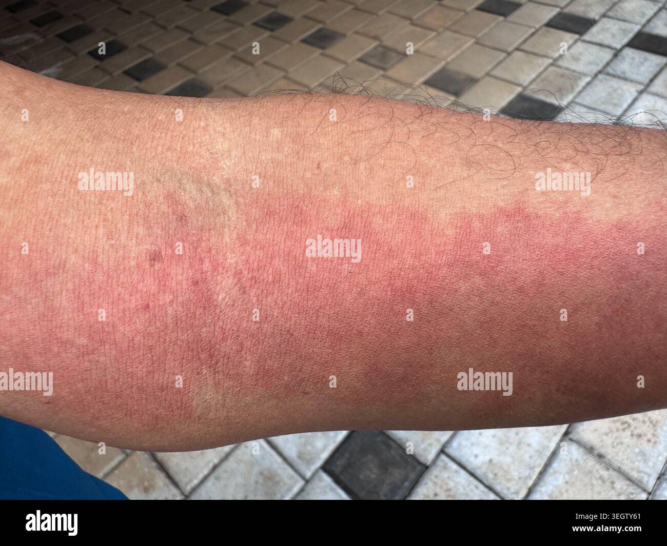 primo piano dettagliato che mostra un'intensa eruzione cutanea infiammatoria rossa, eritema o dermatite allergica sull'avambraccio di una persona Foto Stock