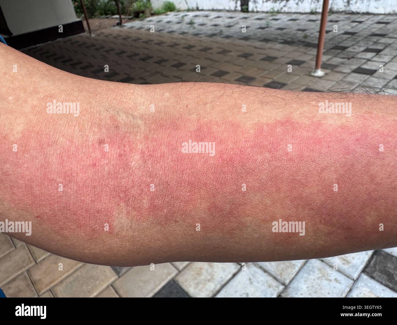 Primo piano di una grave eruzione cutanea rossa su un braccio umano. Sintomo di reazione allergica, orticaria, dermatite o infiammazione sulla pelle. Foto Stock