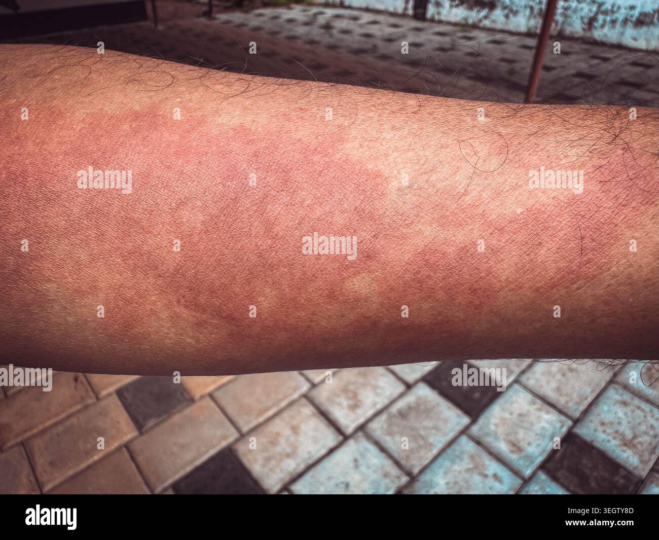 Primo piano di una grave eruzione cutanea rossa su un braccio umano. Sintomo di reazione allergica, orticaria, dermatite o infiammazione sulla pelle. Foto Stock
