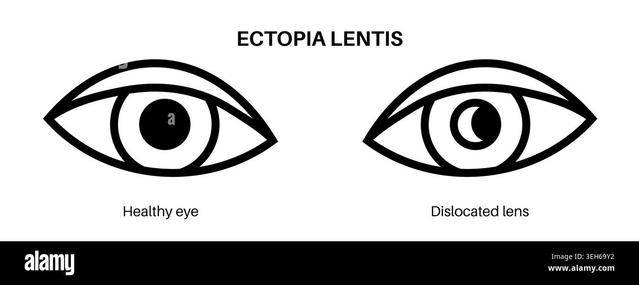 Illustrazione dell'ectopia lentis, lo spostamento dell'obiettivo. Foto Stock