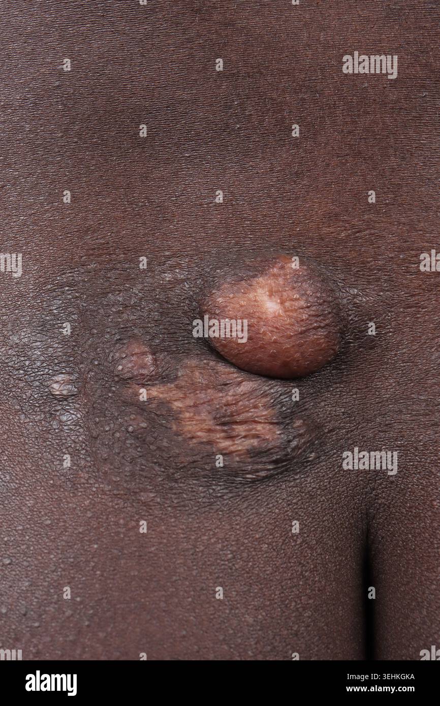 Darrier Ferrand dermatofibrosarcoma della natica in un uomo di 38 anni. Foto Stock