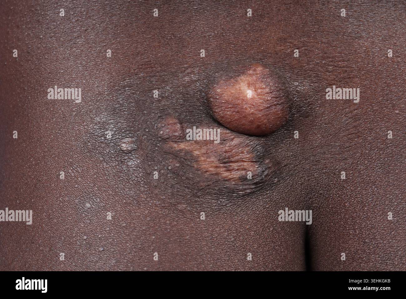 Darrier Ferrand dermatofibrosarcoma della natica in un uomo di 38 anni. Foto Stock