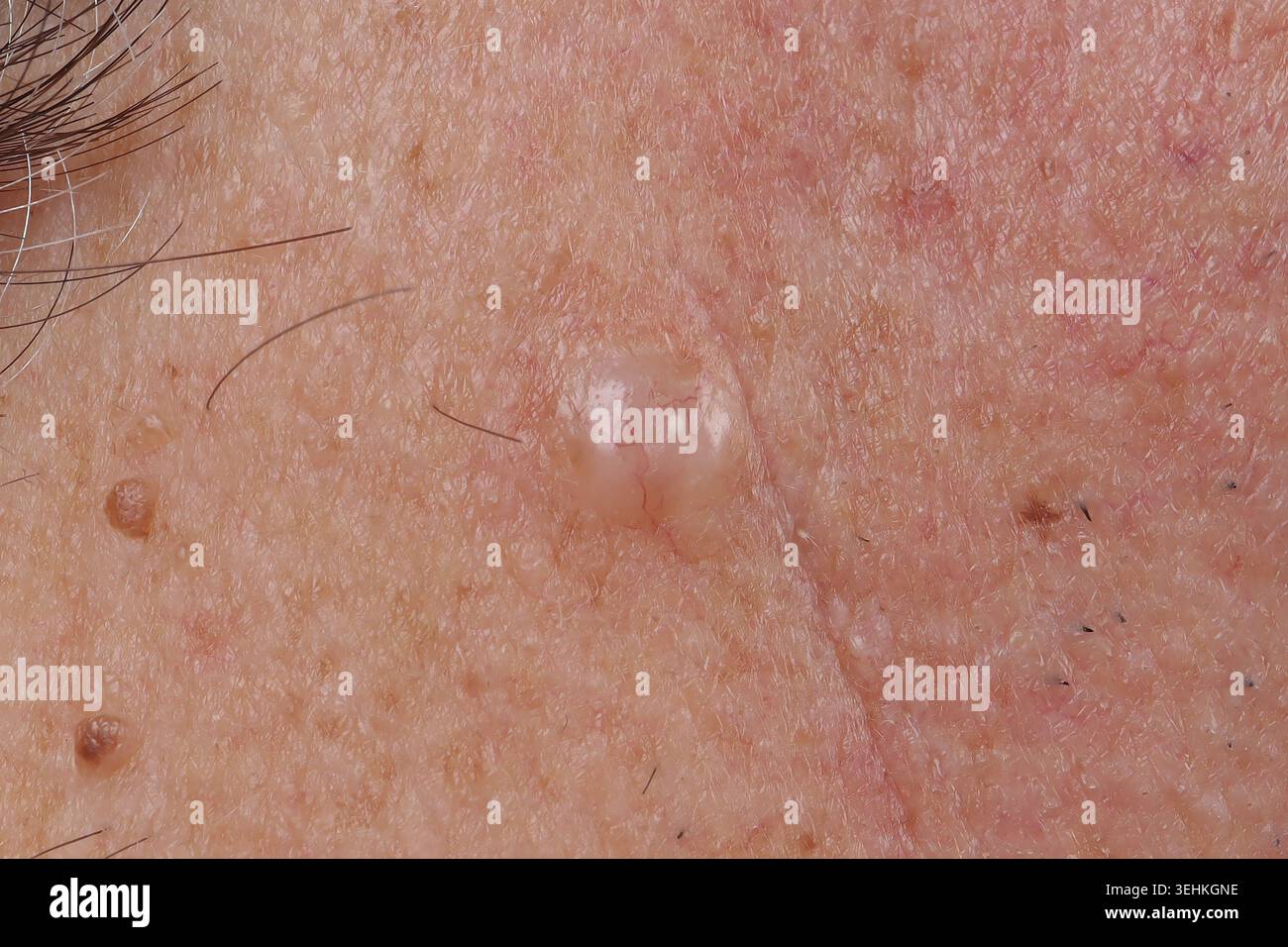 Carcinoma cervicale a cellule basali in un uomo di 72 anni Foto Stock