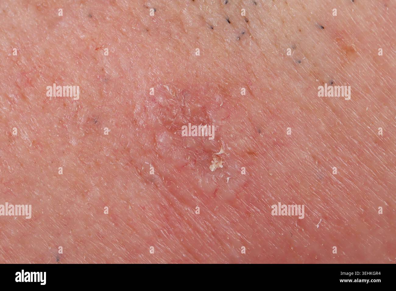 carcinoma a cellule basali in un uomo di 72 anni Foto Stock