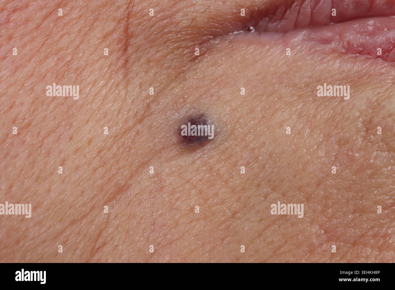Angioma trombosato del labbro senza segni di neoplasia maligna del labbro in una donna di 74 anni. Foto Stock