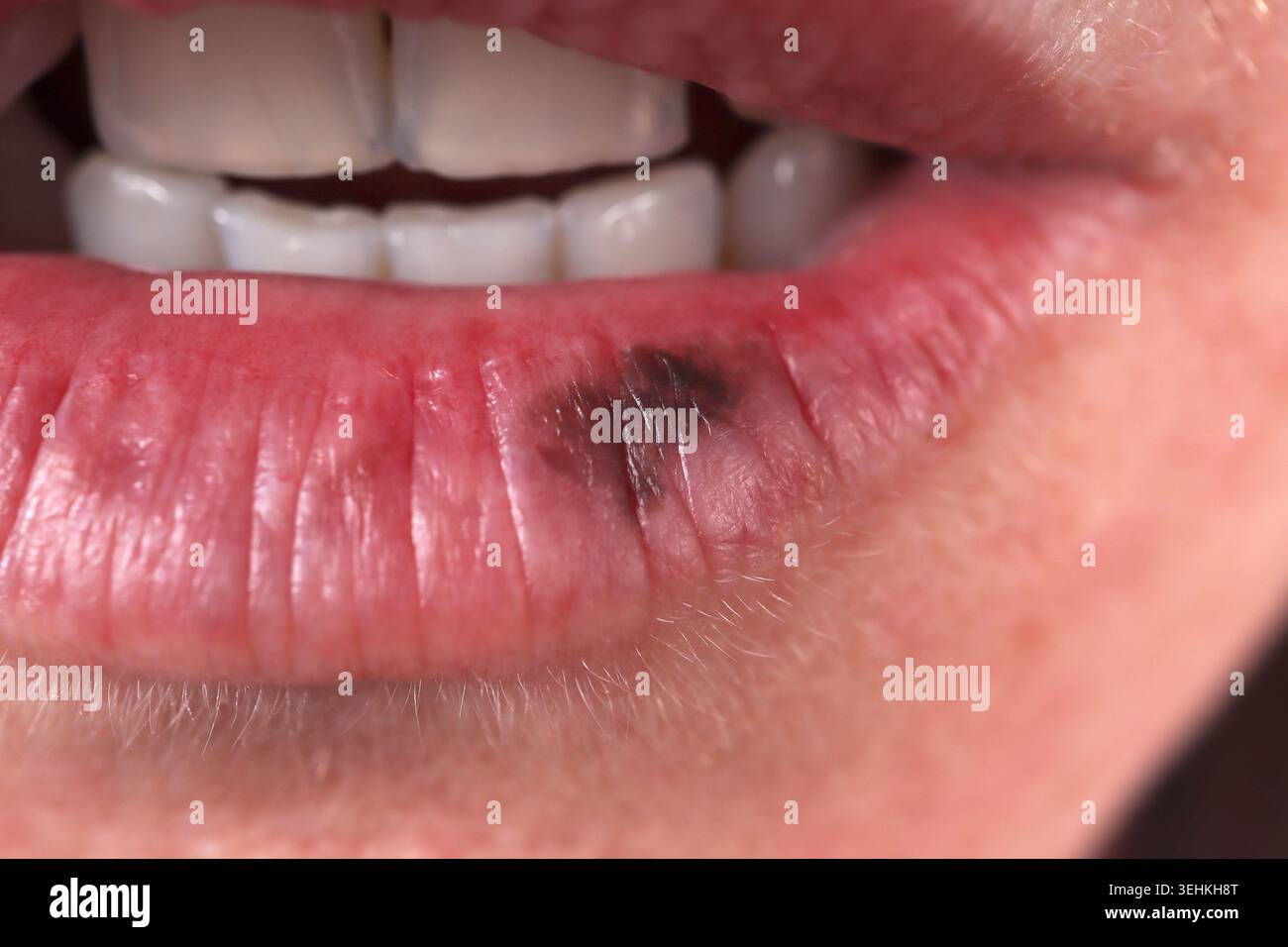 Melanoma del labbro in una donna di 38 anni. Foto Stock