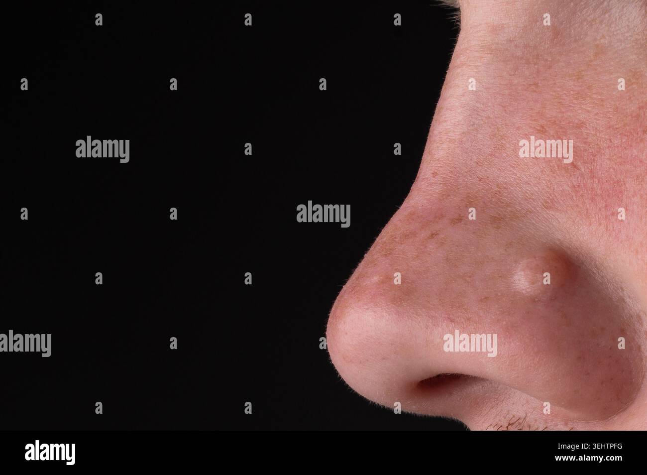 Bump cutaneo sul naso primo piano, consapevolezza del cancro cutaneo e concetto dermatologico 20 Foto Stock