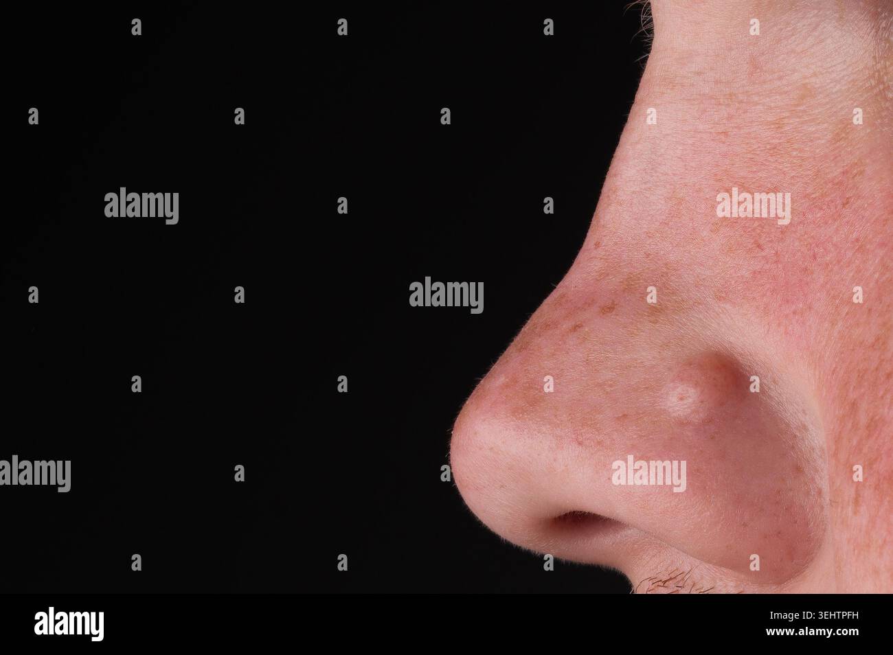 Bump cutaneo sul naso primo piano, consapevolezza del cancro cutaneo e concetto dermatologico 20 Foto Stock