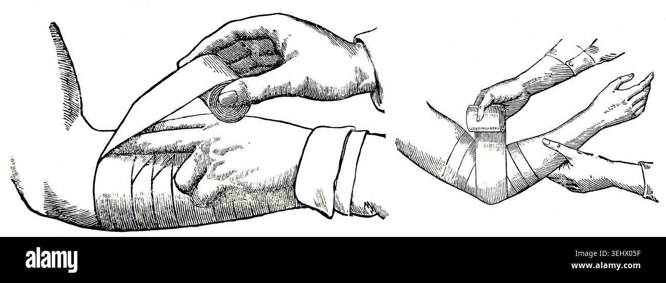 Disegno medico antico che mostra la tecnica di avvolgere una benda intorno al braccio di un paziente utilizzando giri sovrapposti. Foto Stock