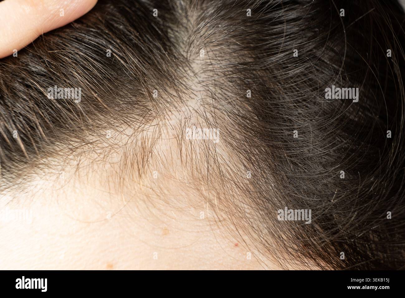 Primo piano di nuovi peli corti che crescono sul cuoio capelluto di una donna dopo il trattamento di perdita dei capelli Foto Stock