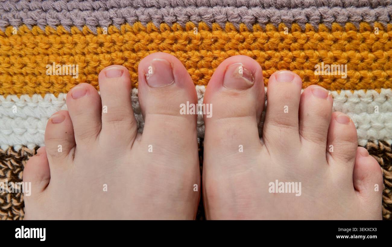 Unghie dei piedi danneggiate poggiate su un tappeto lavorato a maglia Foto Stock