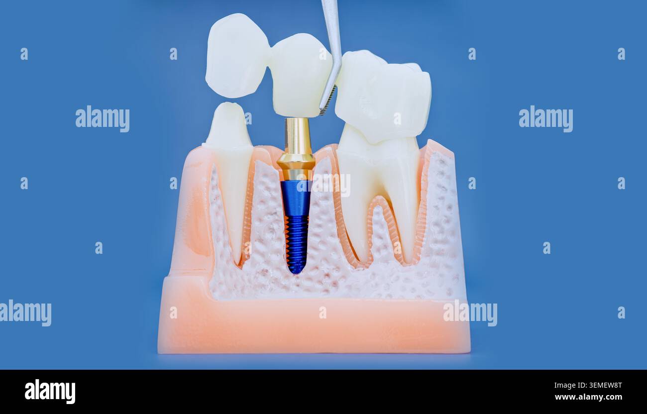 Concetto di implantologia dentale: Restauro di denti con una protesi a ponte in ceramica su un impianto in titanio. Scatto macro. Foto Stock