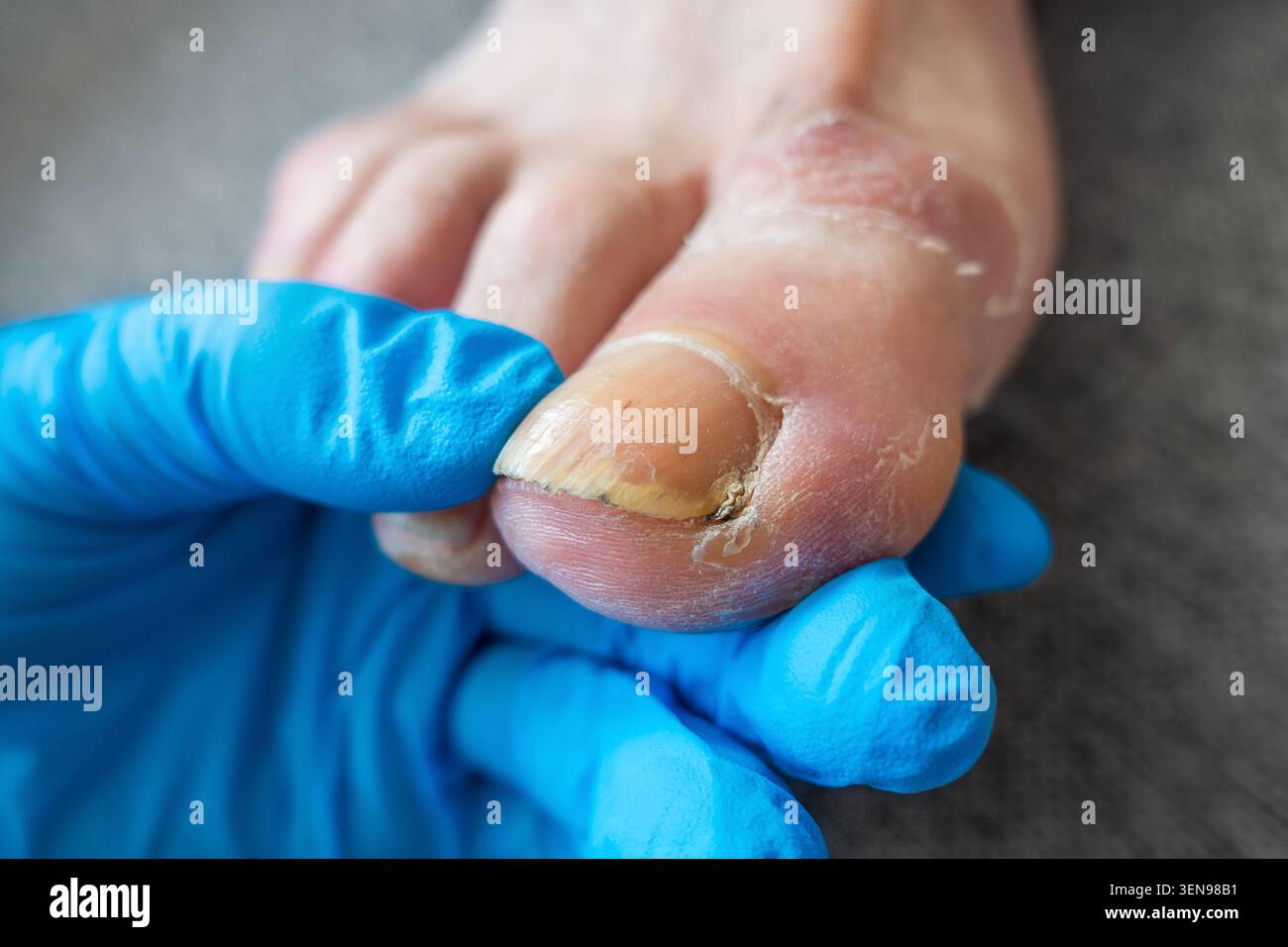 Podiatra che esamina il piede maschio con disturbi dell'unghia del piede usando i guanti medici Foto Stock