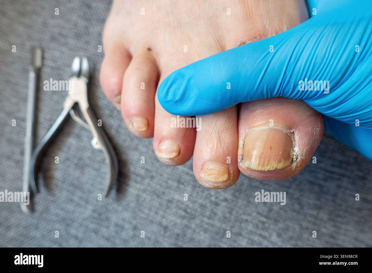 Esame di podiatria del piede maschio con guanti medici e strumenti di trattamento Foto Stock