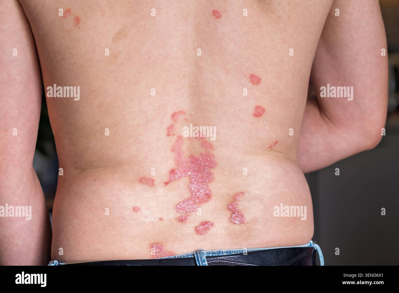 Vista ravvicinata di una schiena maschile che mostra la condizione della pelle della psoriasi con macchie e scaglie rosse, evidenziando l'impatto dei disturbi della pelle sulla salute Foto Stock