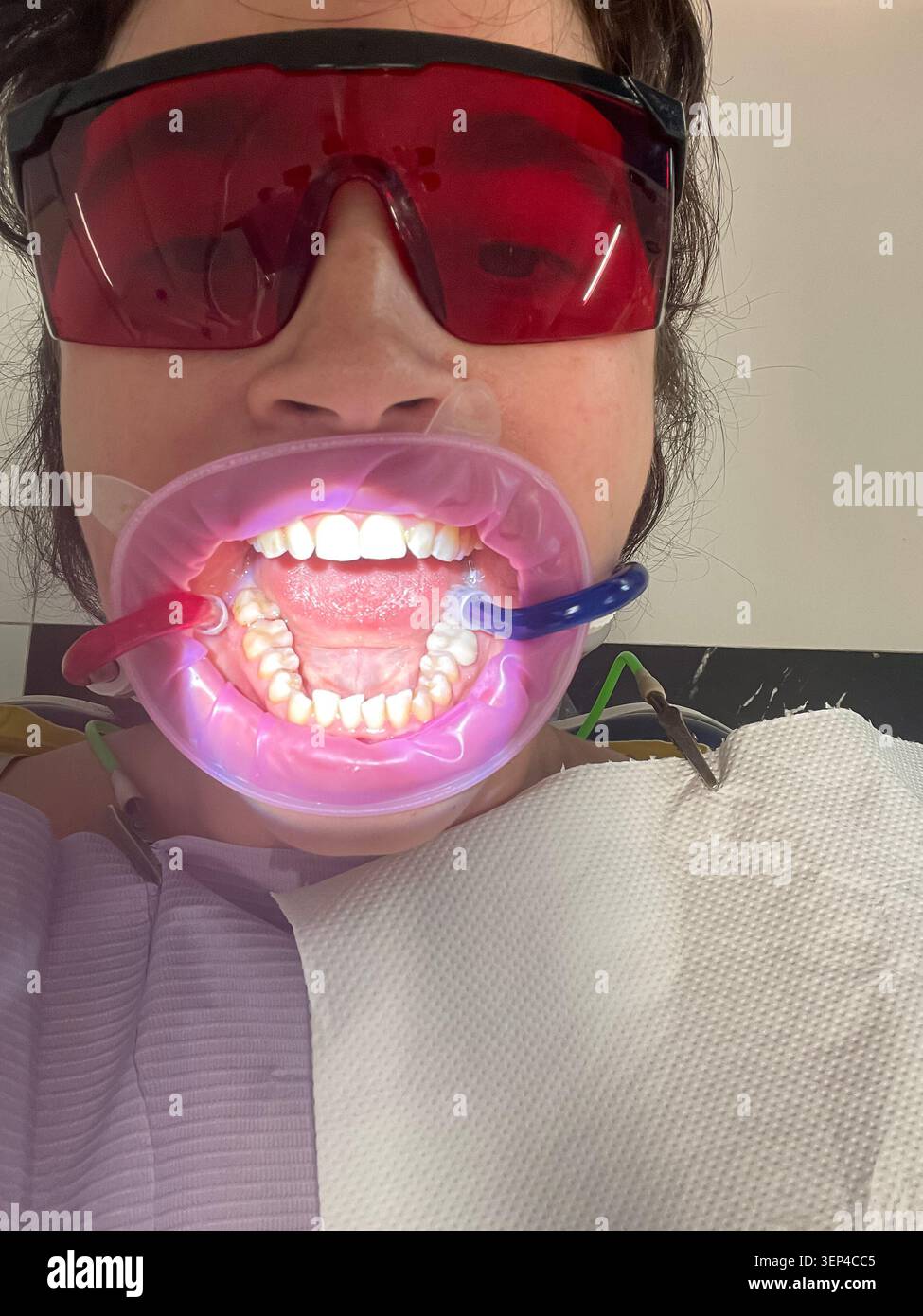 Paziente con dilatatore buccale dentale durante un esame orale e una procedura di trattamento dentale. - Immagine stock catturata con smartphone