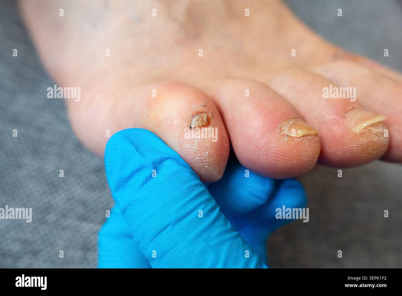 Piccola unghia deformata sul piede maschile Foto Stock