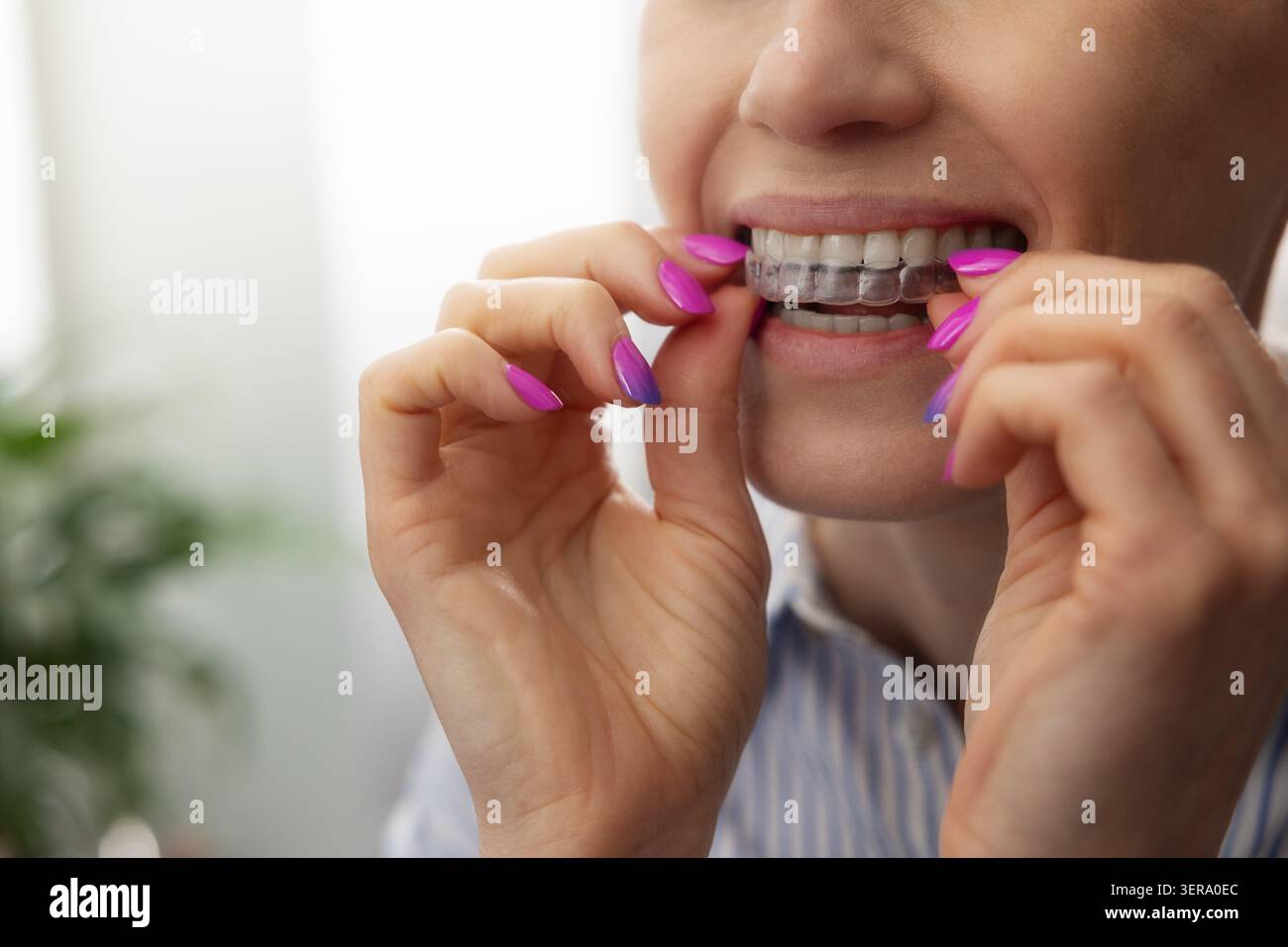 donna che inserisce allineatori dentari invisibili trasparenti per raddrizzare i denti Foto Stock