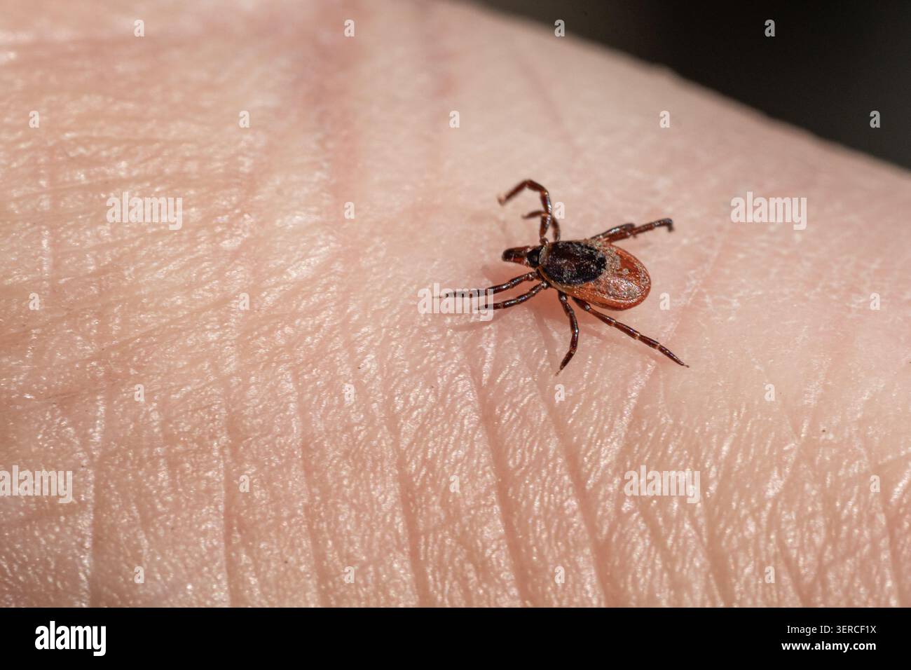 Zecche che strisciano sulla pelle umana. Parassita pericoloso che può trasmettere la malattia di Lyme, encefalite da zecche, anaplasmosi, ehrlichiosi, babesiosi e ot Foto Stock