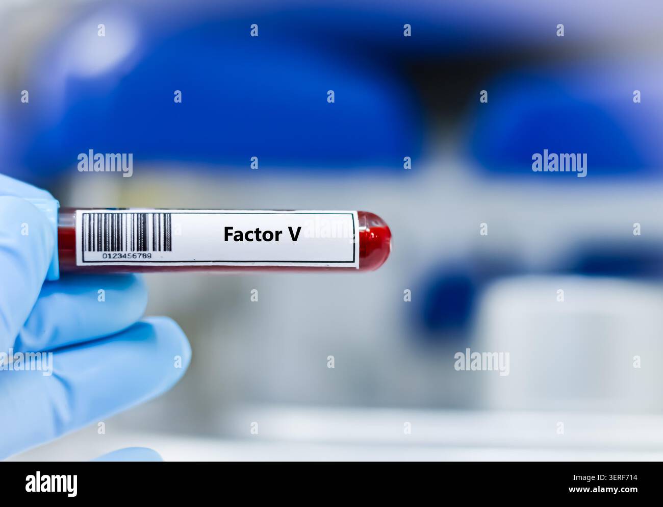 Provetta per campione di sangue per analisi del fattore V. Foto Stock