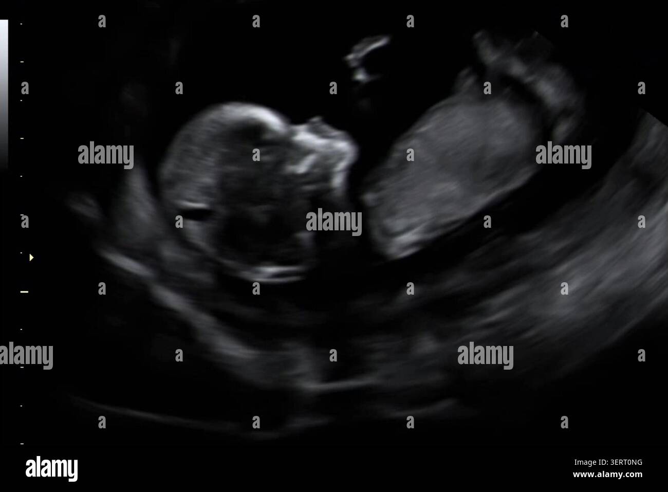 L'ecografia del bambino mostra la crescita di un feto durante un esame di gravidanza prenatale presso una struttura sanitaria. Foto Stock