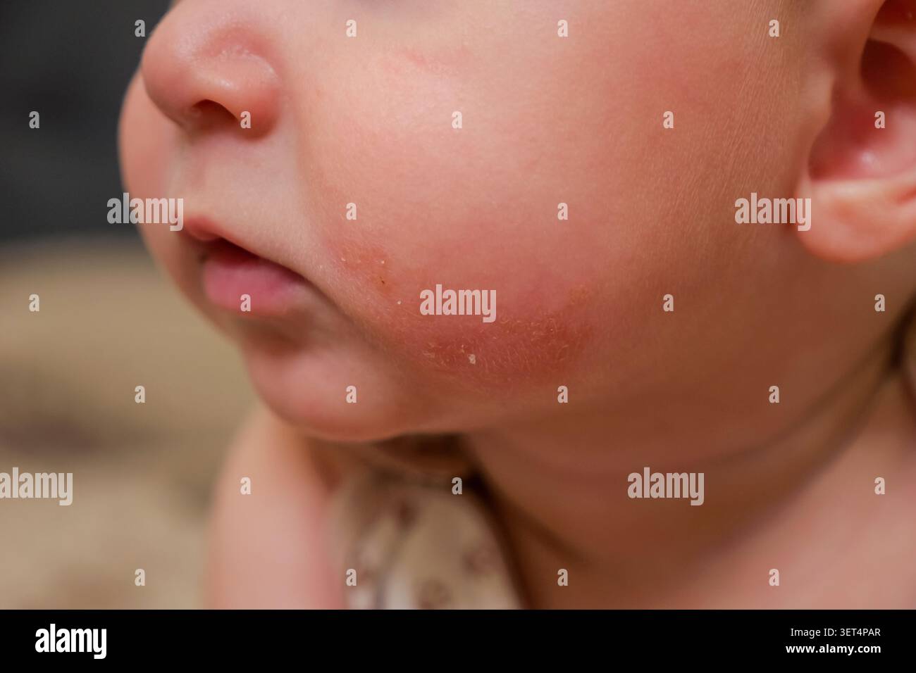 Parte inferiore del viso del neonato con lieve eruzione cutanea delle guance e pelle secca Foto Stock