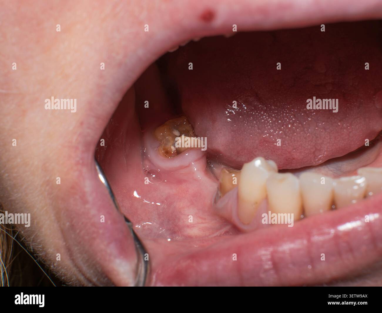 Macro shot di carie dentali su un dente molare in piedi accanto a un sito di estrazione guarito, che mostra una lacuna nella dentatura e danni profondi alla cavità Foto Stock