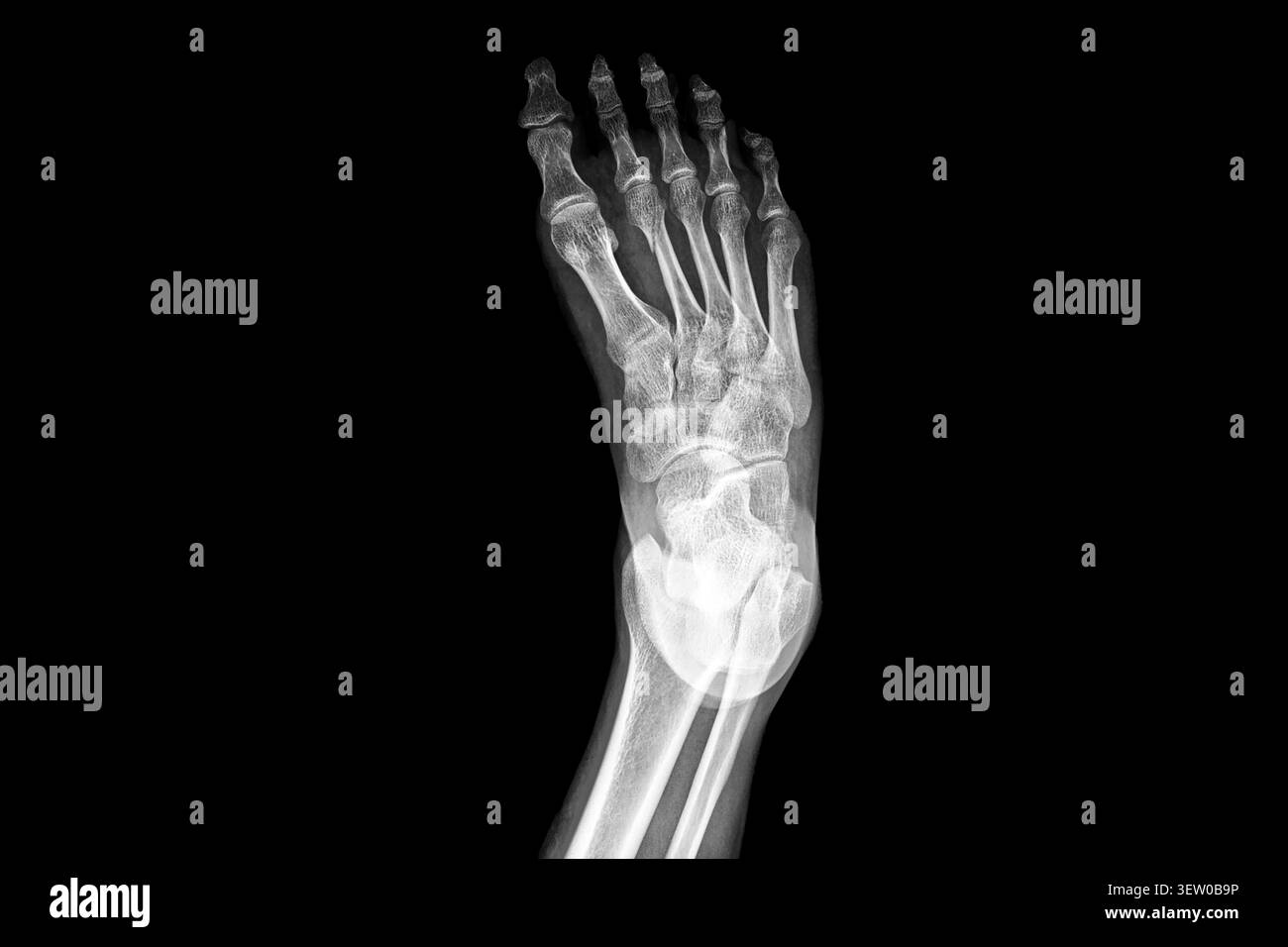 Radiografia dei piedi umani che mostra ossa, articolazioni, dita del piede e struttura scheletrica. Scansione di radiologia medica per la diagnosi ortopedica, podiatria e analisi di frattura Foto Stock