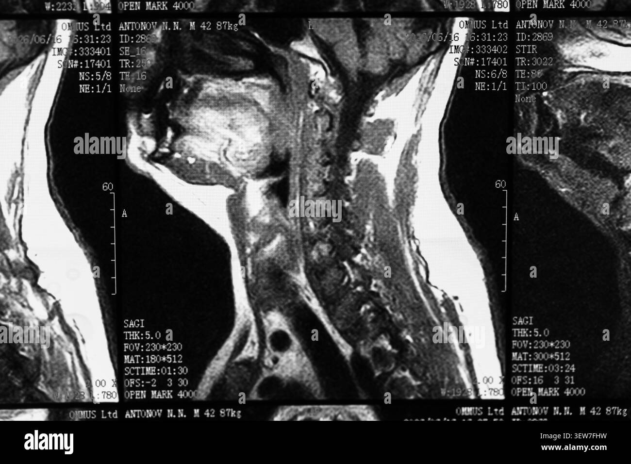 Immagine radiografica RM della vista del collo e della colonna cervicale Foto Stock