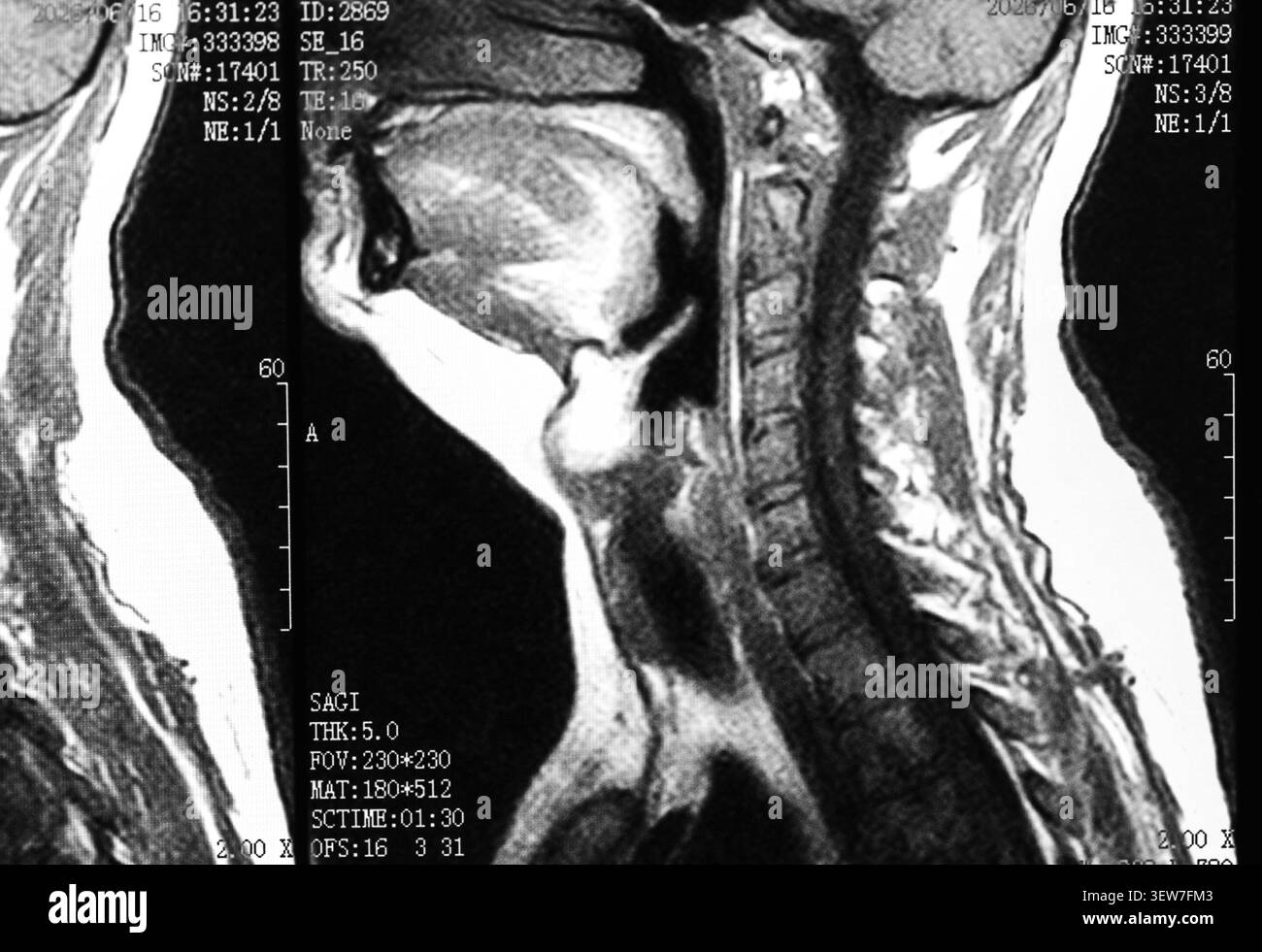 Immagine radiografica RM della vista del collo e della colonna cervicale Foto Stock