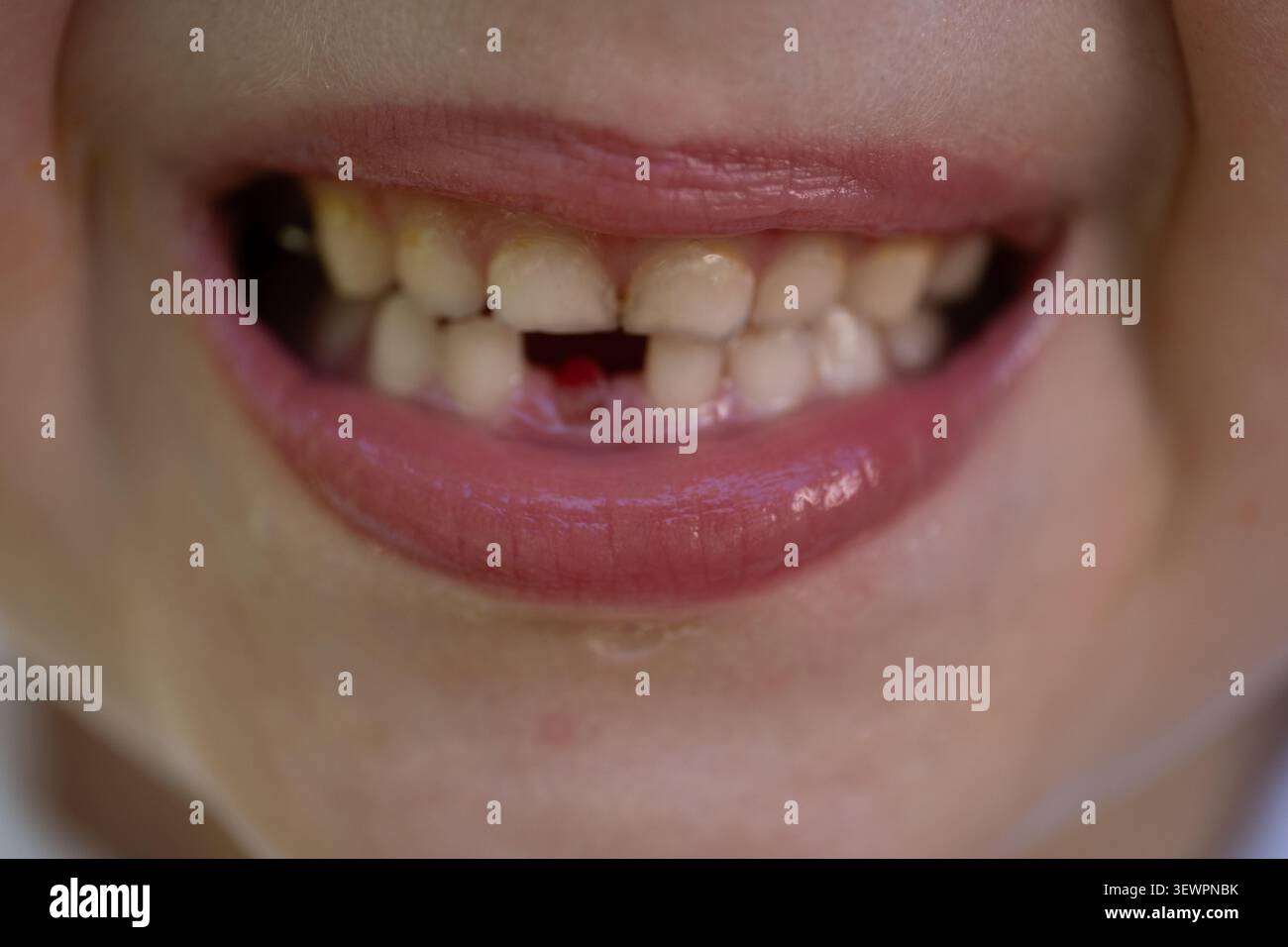 Primo piano di un bambino sorridente subito dopo la naturale perdita di un dente del bambino, mostrando la fessura fresca prima che il dente permanente emerga. L'immagine il Foto Stock