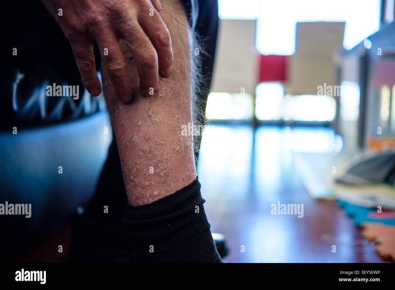 La mano della persona graffiando una gamba prurito influenzata da una condizione cronica della pelle Foto Stock