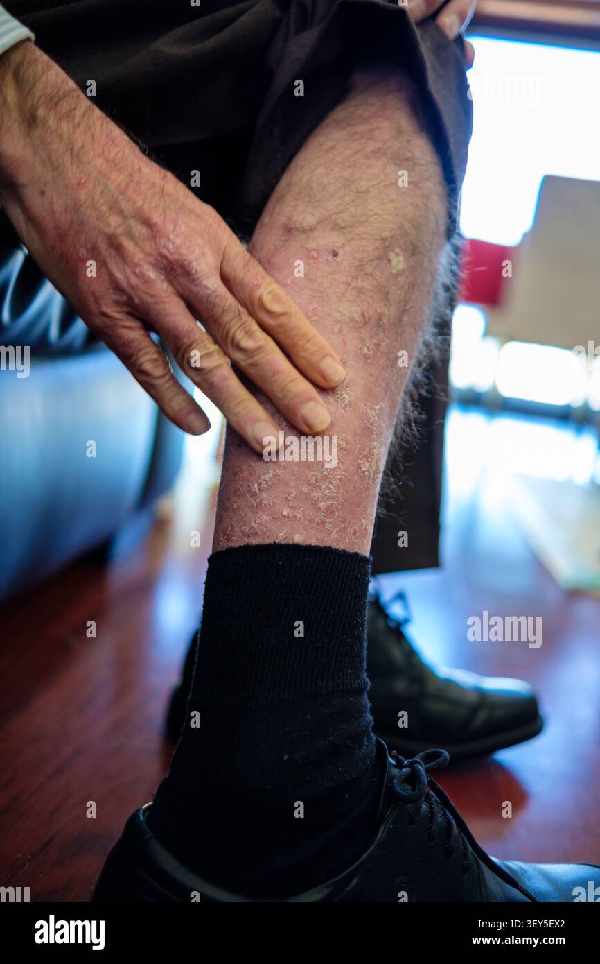 Gamba di persona anziana che soffre scale e infiammazione da una malattia cronica della pelle Foto Stock